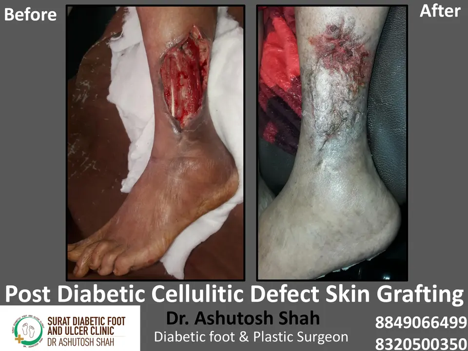 Diabetic Foot  PPT 3 checked by sir.pptx-59.webp